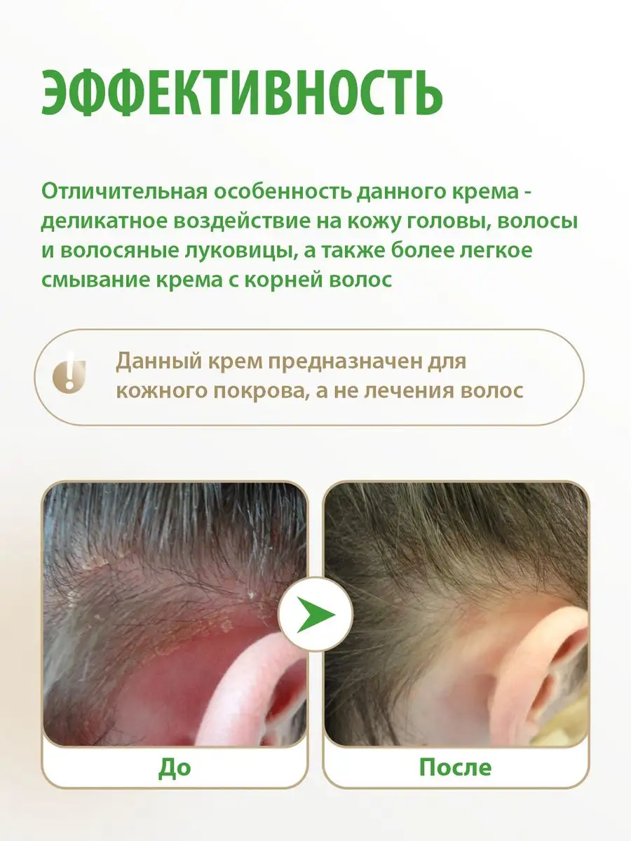 Крем Акрустал для ВЧГ 65 мл для ухода за кожей головы при псориазе, себорейном дерматите, себорейной экземе, сухости, шелушениях